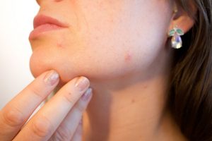 Wat te doen tegen acne